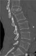 Burst Fracture-Lumbar Spine